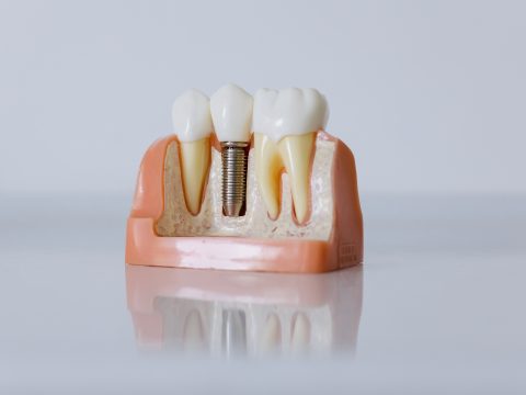 implantes dentales acapulco