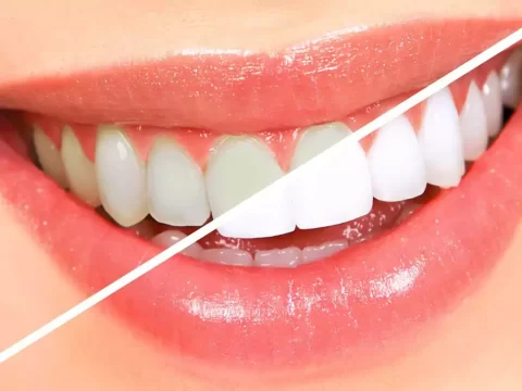 Qué es el blanqueamiento dental y cómo funciona